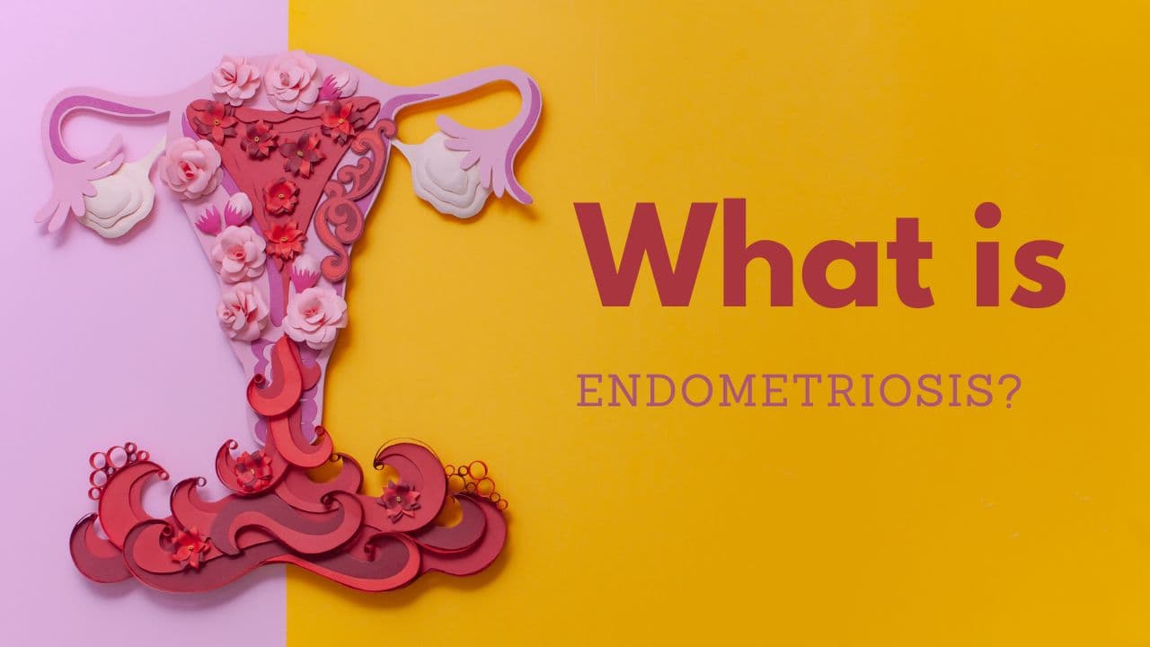 What is Endometriosis educational graphic with uterus illustration